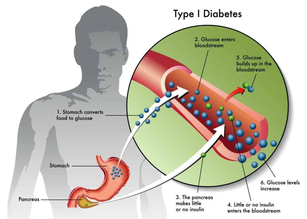a diagram showing type 1 diabetes