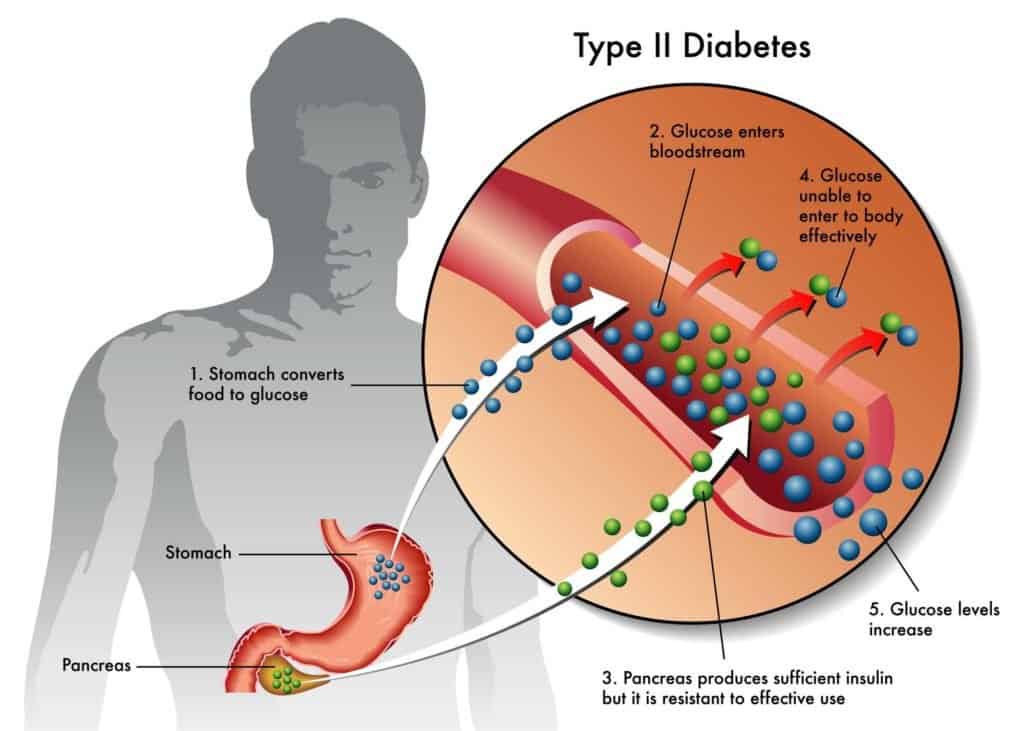 a graphic showing type II diabetes.
